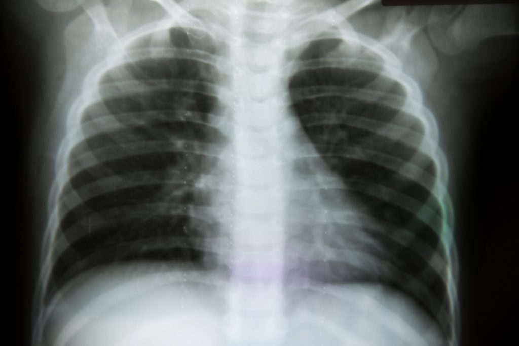 AI brings faster, life-saving TB screenings to communities with limited healthcare access