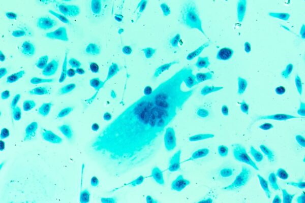 A new drug is producing “stunning” results in men with advanced prostate cancer