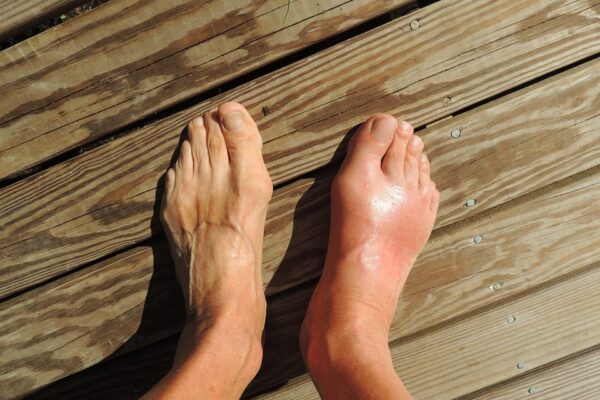 6 Foods that naturally lower uric acid levels and prevent gout