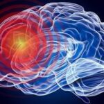 The Impact of Stroke on Speech Comprehension stroke-speech-comprehension