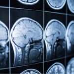 Brain-Injury-Cases-scaled-1