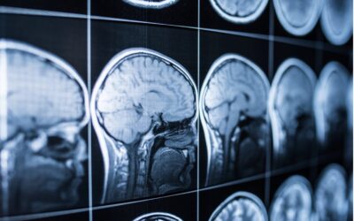 Why Brain Injury Cases Are Harder to Prove Than You Think –