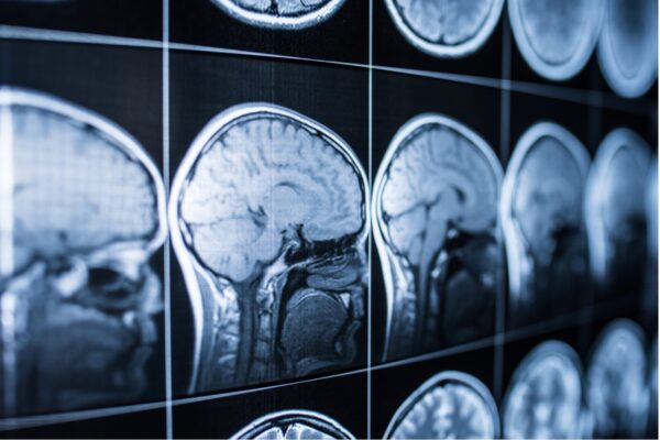 Why Brain Injury Cases Are Harder to Prove Than You Think –