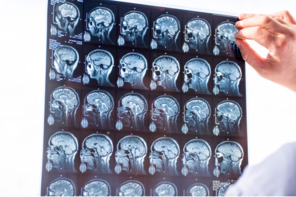 What Makes Traumatic Brain Injury Cases More Complex Than Other Injury Claims –