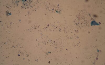 The new TB diagnostic that could replace 150 years of microscope testing