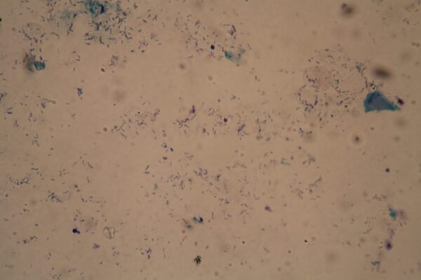 The new TB diagnostic that could replace 150 years of microscope testing