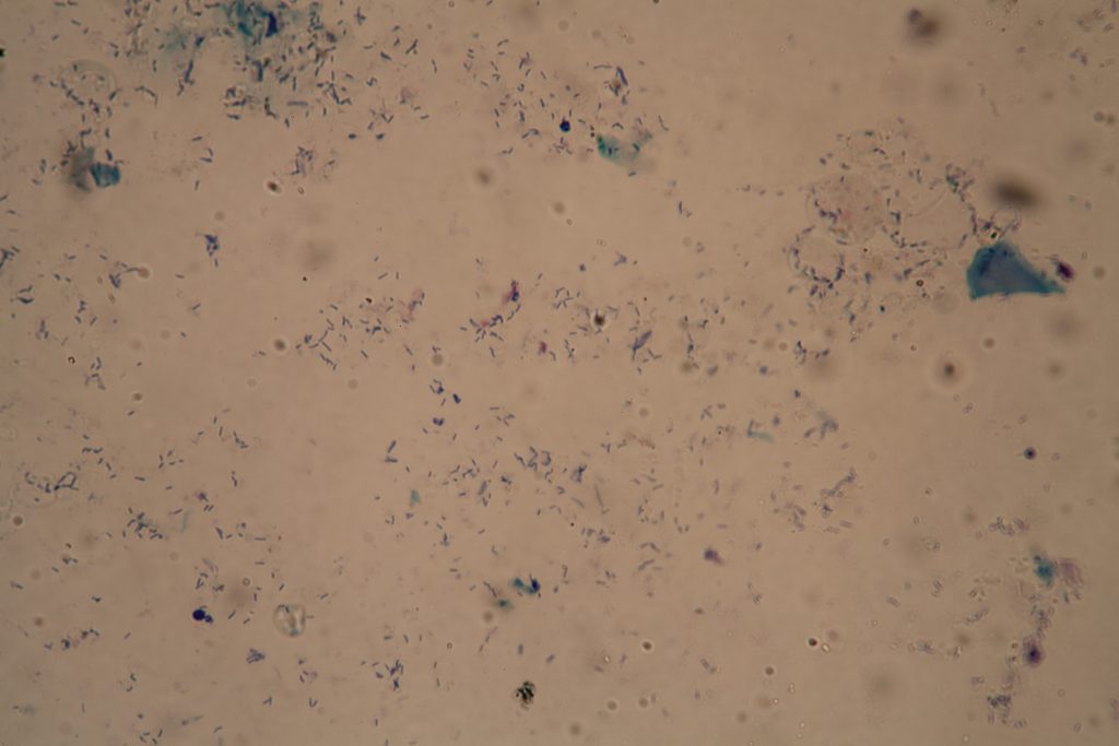 The new TB diagnostic that could replace 150 years of microscope testing