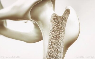 The bone density fraud: How a flawed test and toxic drugs created a multi-billion dollar medical myth