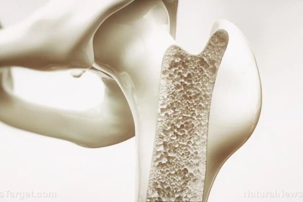 The bone density fraud: How a flawed test and toxic drugs created a multi-billion dollar medical myth