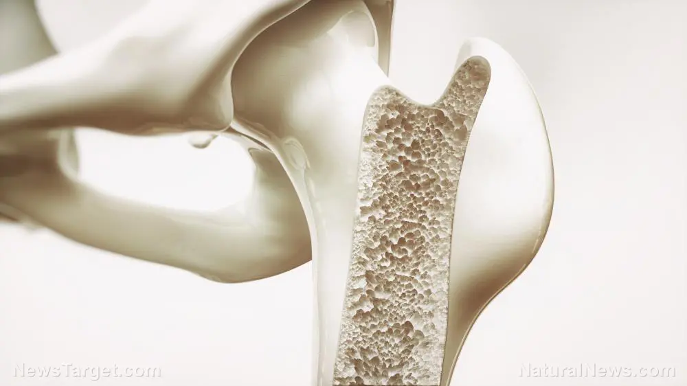 The bone density fraud: How a flawed test and toxic drugs created a multi-billion dollar medical myth