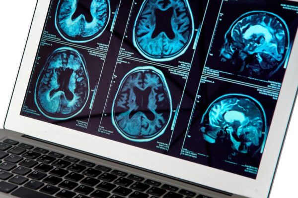 Copper compound targets Alzheimer’s at the blood-brain barrier