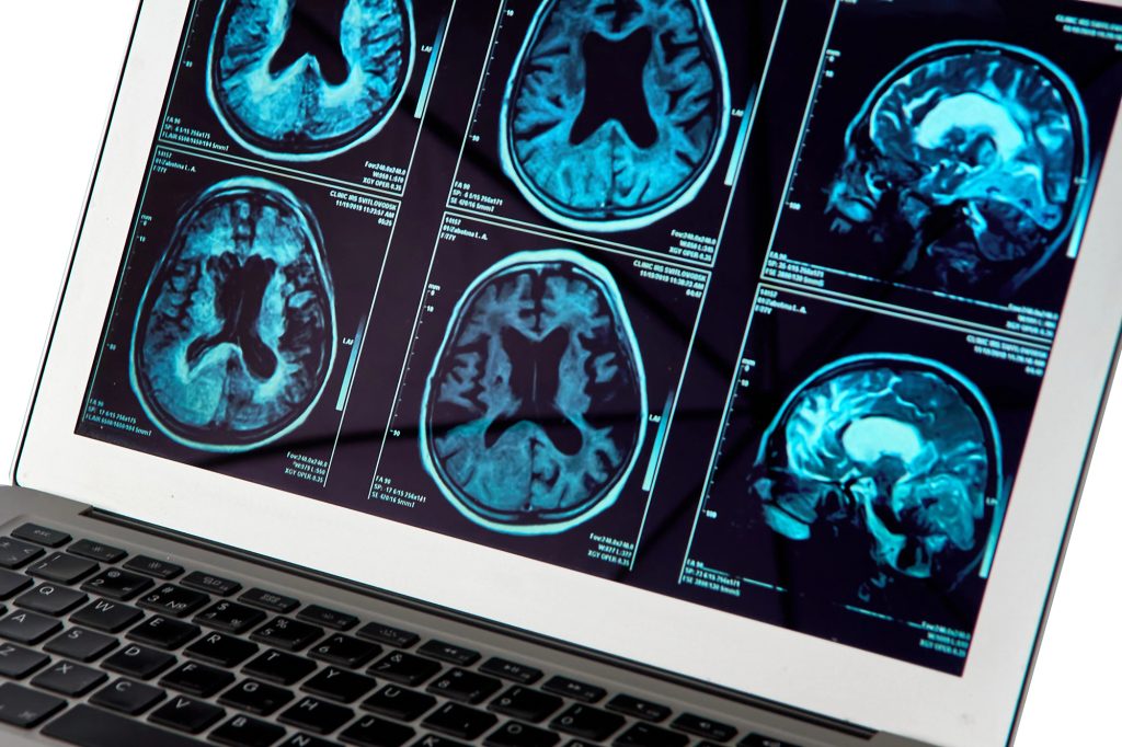 Copper compound targets Alzheimer’s at the blood-brain barrier