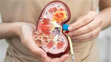 Chronic Kidney Disease: A Hidden Threat to Your Heart