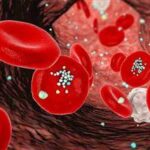 Study Links Microplastics in Arterial Plaque to Fourfold Increase in Stroke Risk microplastics-arterial-plaque-thumb