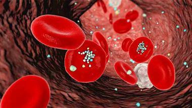 Study Links Microplastics in Arterial Plaque to Fourfold Increase in Stroke Risk