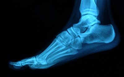 3D-printed bone implants that release drugs as they heal