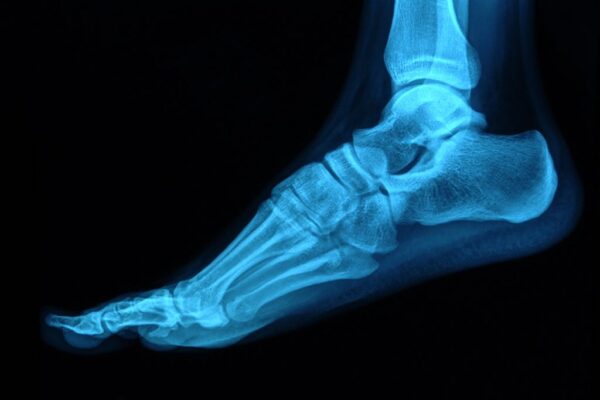 3D-printed bone implants that release drugs as they heal