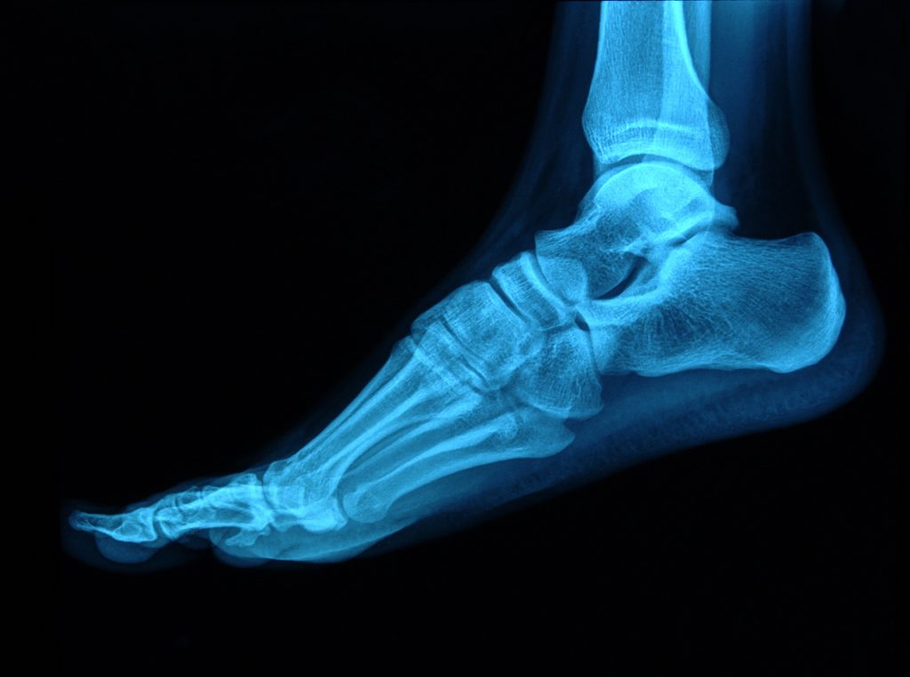 3D-printed bone implants that release drugs as they heal