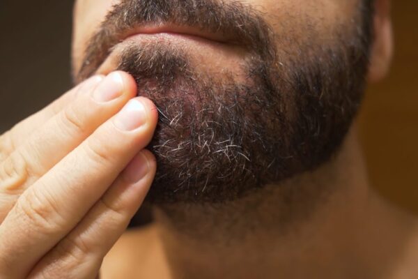 Beard dandruff remedies dermatologists swear by