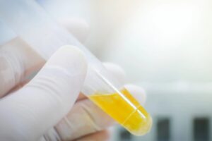 At-home urine test spots bladder cancer in nine of ten cases