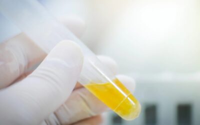 At-home urine test spots bladder cancer in nine of ten cases