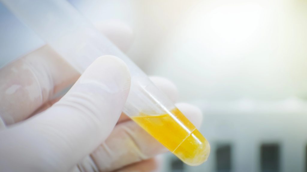 At-home urine test spots bladder cancer in nine of ten cases