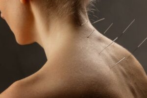 Dry needling: How it rewires pain and restores muscle