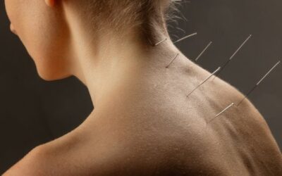 Dry needling: How it rewires pain and restores muscle