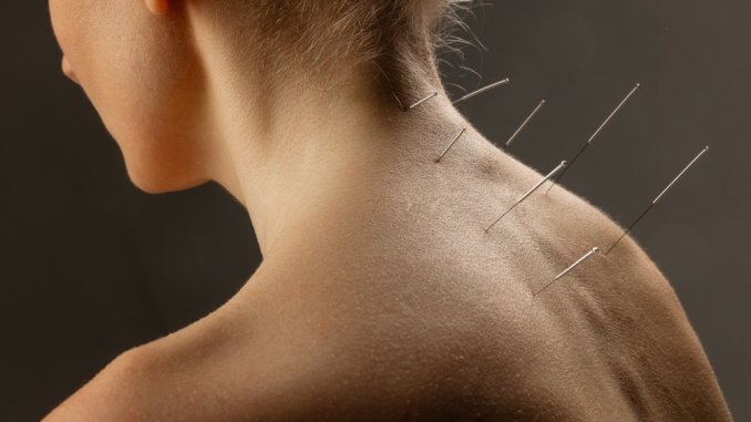 Dry needling: How it rewires pain and restores muscle